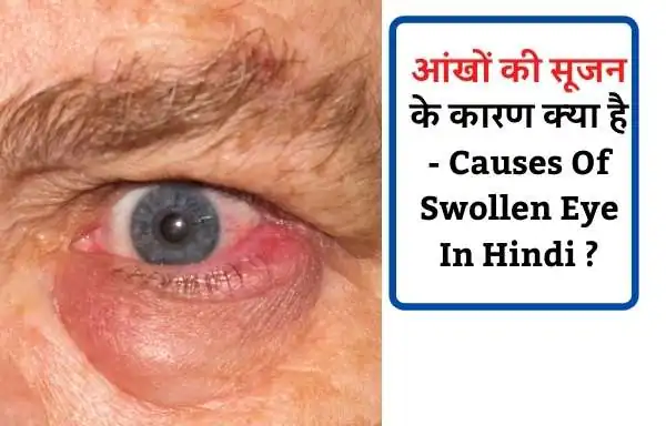 आंखों की सूजन के कारण क्या है | Causes Of Swollen Eye In Hindi ?