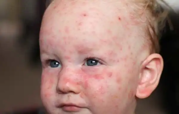 Chickenpox ke lakshan - Chickenpox Symptoms in Hindi