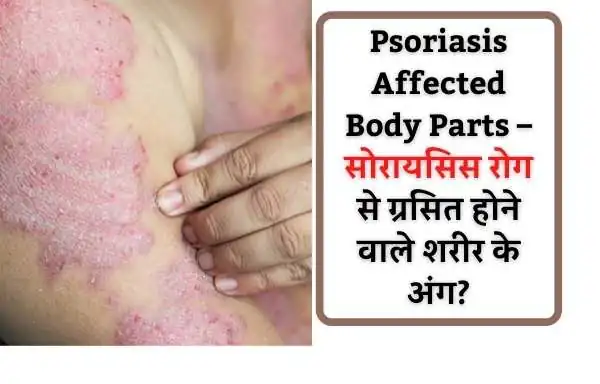 psoriasis ayurvedic treatment in hindi | Psoriasis Hone Ke Karan - Causes Of Psoriasis In Hindi