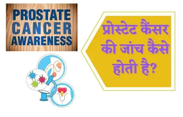 Prostate Cancer Ka ilaj | Treatment Of Prostate Cancer?