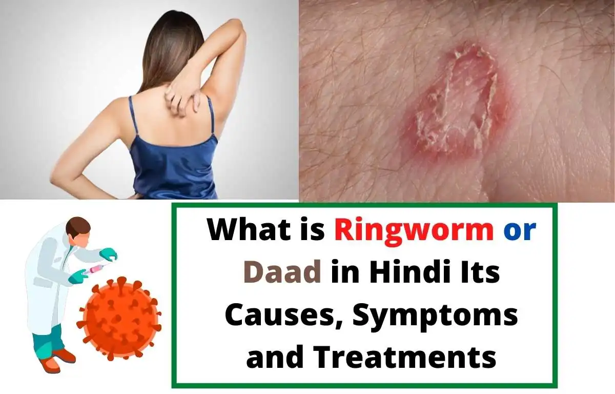 What is Ringworm or Daad in Hindi Daad ke Lakshan, 9 Best Gharelu Upay - दाद (रिंगवार्म) होने के कारण (Ringworm Causes and 9 Home Remedies in Hindi)