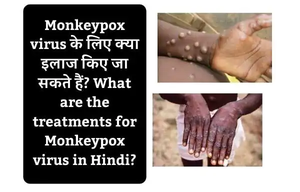 Monkeypox virus के लिए क्या इलाज किए जा सकते हैं? | What are the treatments for Monkeypox virus in Hindi?
