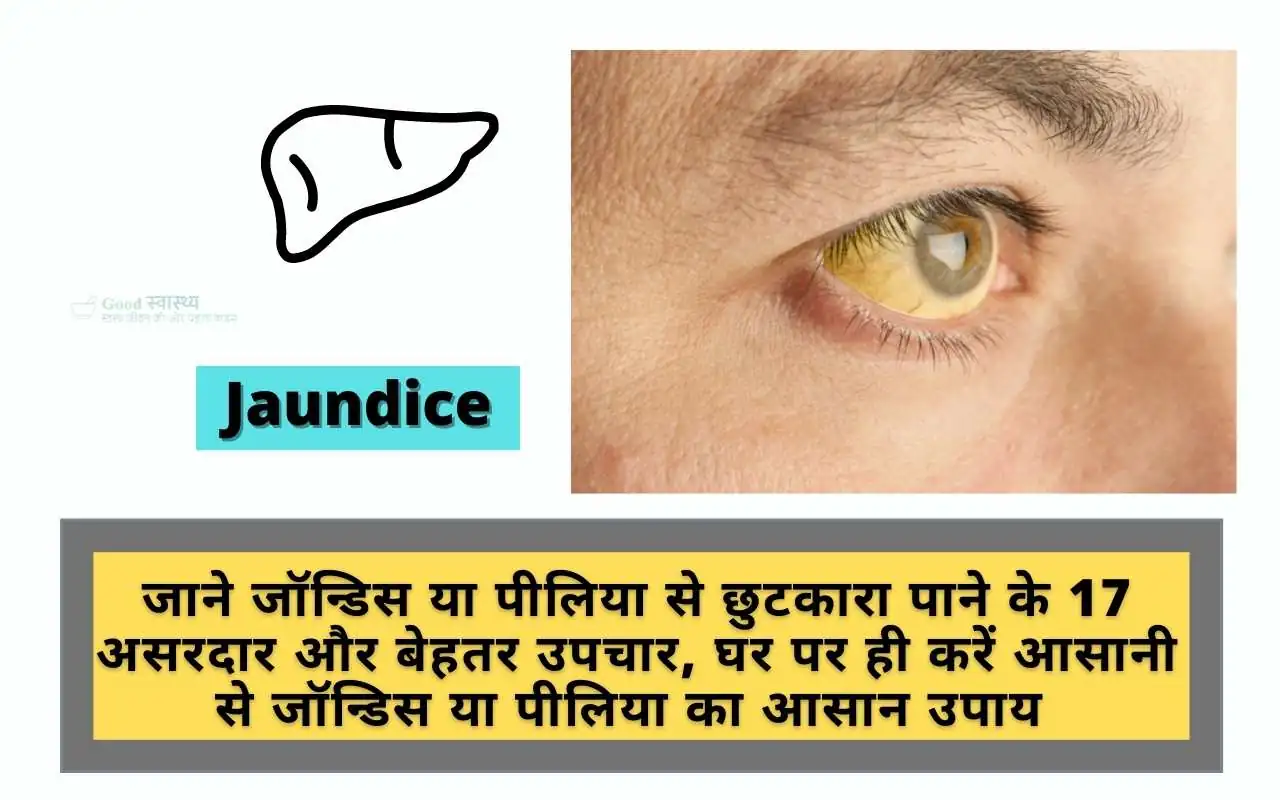 Jaundice Treatment : जाने जॉन्डिस या पीलिया से छुटकारा पाने के 17 असरदार और बेहतर उपचार, घर पर ही करें आसानी से जॉन्डिस या पीलिया का आसान उपाय | 17 Best Home Remedies and Treatment for Jaundice in Hindi
